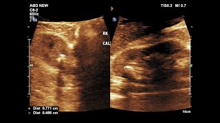 Nephrolithiasis  Renal Calculi  Ultrasound  Case 08 [upl. by Giff]