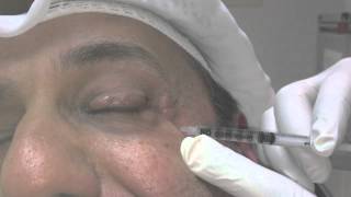 Blepharospasm and Botox Treatment [upl. by Triley]