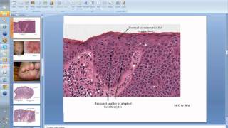 Dermpath SCC and KA [upl. by Lerat]