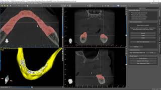 Bone Segmentation Using Blue Sky Plan [upl. by Nelehyram]