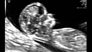 Ultrasound Video Part One 12 Weeks amp 2 Days Its a girl 101512 [upl. by Aisaim]