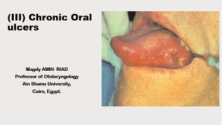 III Chronic Oral Ulcers [upl. by Rahsab551]