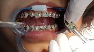 Braces Installation [upl. by Nauhs]