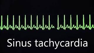 Cardiovascular System 8 Normal and abnormal heart rhythms [upl. by Nella]