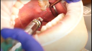 Inferior Alveolar Nerve Block Demonstration and Overview 4K [upl. by Yeltnerb248]