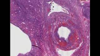 Histopathology Ovary Polycystic ovarian disease SteinLev [upl. by Waylen]