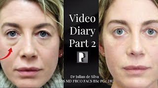 Blepharoplasty Video Diary  Day 2 After Surgery 2 of 15 [upl. by Ambrose]