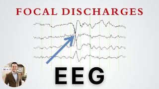 Focal Discharges on EEG and what they mean in Epilepsy [upl. by April641]