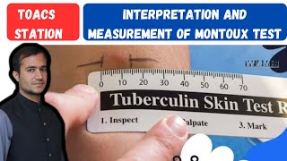 Tuberculin skin test measurement and interpretation positive PPD montoux test patient tuberculosis [upl. by Flosi223]