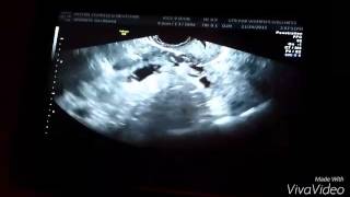 6w4d miscarriage ultrasound [upl. by Gracye]