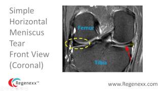 How to Read a Knee MRI for Meniscus Tears [upl. by Aterg]