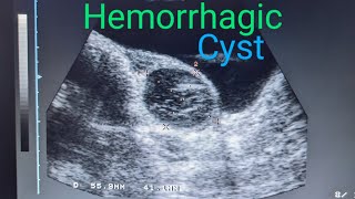 Ovary Hemorrhagic Cyst medicalimagingbyzubair ultrasound [upl. by Tezzil]