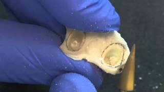 How to reline a processed Temporary by Dr Marshall Fagin Prosthodontist [upl. by Noslen]