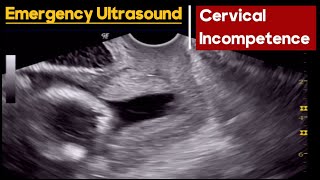 Cervical Incompetence  How to Diagnose  Abdominal vs TVS Ultrasound [upl. by Charline]