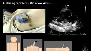 05 Right ventricular inflow amp outflow views [upl. by Airad23]