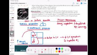 Pulsus paradoxus cardiology 110  First Aid USMLE Step 1 in UrduHindi [upl. by Adnauqaj]