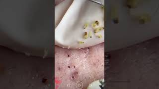 Skincare  Blackheads Removal 201 skincare skincare blackheads blackheads [upl. by Dyraj]