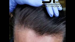 Scalp Micropigmentation for thinning hair increasing hair density [upl. by Eiralih]