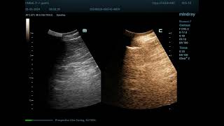 Hemangioma 29 CEUS [upl. by Diet]