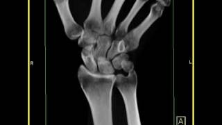 Wrist Anatomy Healing fracture of the scaphoid with a small cyst 1 of 2 [upl. by Jurdi224]