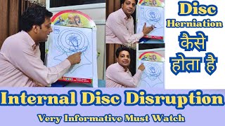 Internal Disc Disruption  Mechanism Behind Disc Herniation  Dr Rajesh Sharma PT [upl. by Eelana]