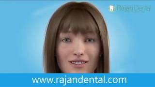 Clear Positioner Dental Treatment  Invisible Aligners  Rajan Dental [upl. by Eon]