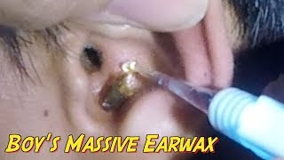 Boys Massive Earwax Removal from Both Ears [upl. by Selinda570]