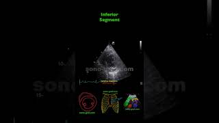 Echocardiography  Inferolateral And Inferior Hypokinesia [upl. by Nnomae]