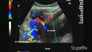 Color Doppler video of uterine artery in 2nd trimester [upl. by Artemahs]