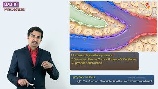 2Edema Pathogenesis  Hemodynamic pathology Fmge amp Neet PG [upl. by Ymac689]