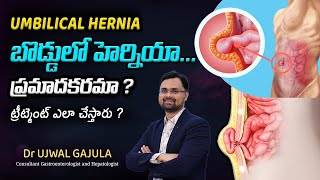 Umbilical Hernia Causes  Umbilical Hernia Symptoms  Umbilical Hernia Treatment  Dr Ujwal Gajula [upl. by Akcira971]