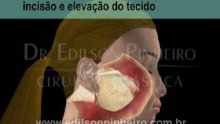 Lifting Facial  Cirurgia Plástica em 3D  Antes e Depois [upl. by Halullat388]