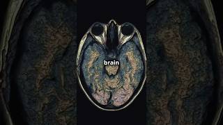 MetachromaticLeukodystrophy step2 medicalstudent genetics usmle DiagnosticLens [upl. by Nitin]