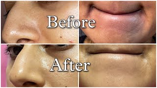 How I got rid of BLACKHEADS amp WHITEHEADS completely [upl. by Adyaj253]