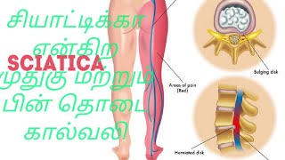 L4  L5 Disc Bulge  WITHOUT SURGERY  RECOVERY VIDEO in Tamil  Sun Hospital  Madurai [upl. by Rillis961]