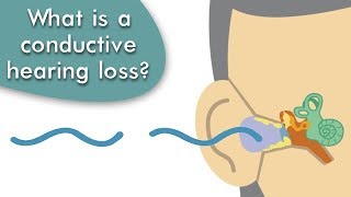 Conductive Hearing Loss Explained [upl. by Aener]