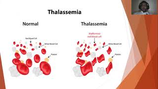 Management of Patients with Nonmalignant Hematologic Disorders Part II [upl. by Marabelle]