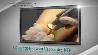 Traitement de la rosacee couperose Centre Epilation Laser et Médecine Esthétique 91310 Montlhéry [upl. by Ketchan895]