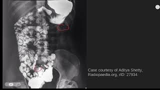 Midgut malrotation radiology abr core [upl. by Aleksandr]