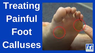 How to Treat Painful Foot Calluses [upl. by Aileahcim]