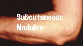 Brief information on Subcutaneous Nodules [upl. by Adgam813]