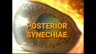 Ep 5 POSTERIOR SYNECHIAECLINICAL DISCUSSION ON SLIT LAMP [upl. by Rosanne491]