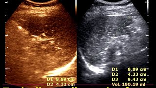 Granulomatous lesions of the spleen  Practical Ultrasonogram Spleen  Lymphoma Spleen [upl. by Naesyar]