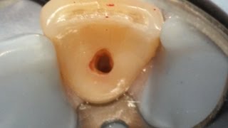 Internal resorption treatment with narration [upl. by Razatlab]