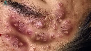 Big Cystic Acne Blackheads Extraction Blackheads amp Milia Whiteheads Removal Pimple Popping [upl. by Natrav747]