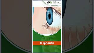 Blepharitis  SBH Hospital  What Is Blepharitis  Chhattisgarh [upl. by Finstad]