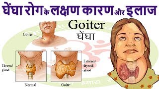 घेंघा  Goiter  रोग Enlarged Thyroid Gland के लक्षण कारण और इलाज [upl. by Zilevi]