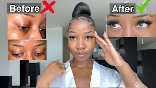 HOW TO GET RID OF DARK CIRCLES PERMANENTLY 👀 Fast and Effective [upl. by Emanuela]