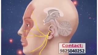 Trigeminal neuralgia treatment radio frequency ablation in ahmedabad gujrat [upl. by Dorran]