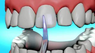 Dental Bonding Video  Tooth Bonding [upl. by Nora]